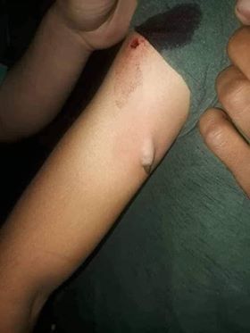 إصابة طفلة برصاص ميليشيا الحوثي بصنعاء "صورة"