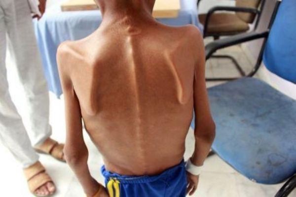 تقرير أممي يحذر من شبح مجاعة يهدد اليمنيين ويدعو للتدخل الإنساني
