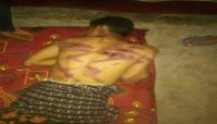 الحوثيون يختطفون شابا في "الحديدة" ويعذبونه بصورة وحشية (اسم وصورة)