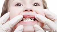 ما مرض الأسنان الطباشيرية؟